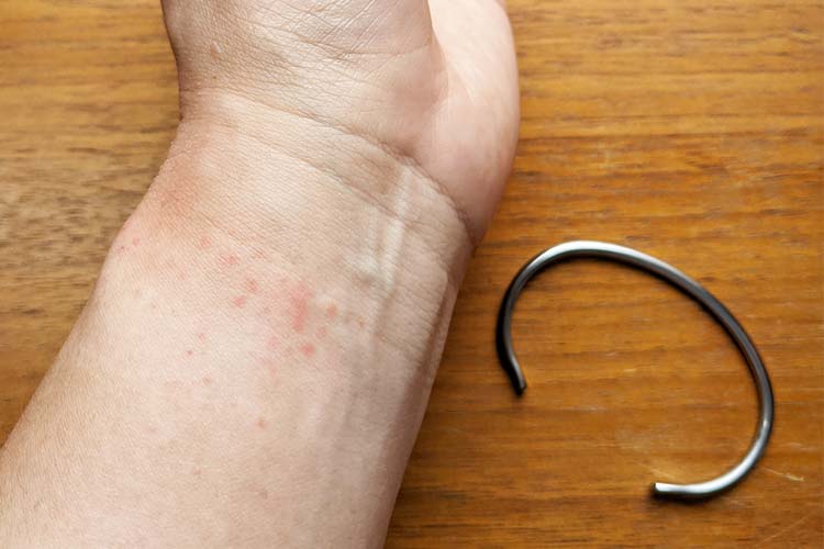 金属アレルギー