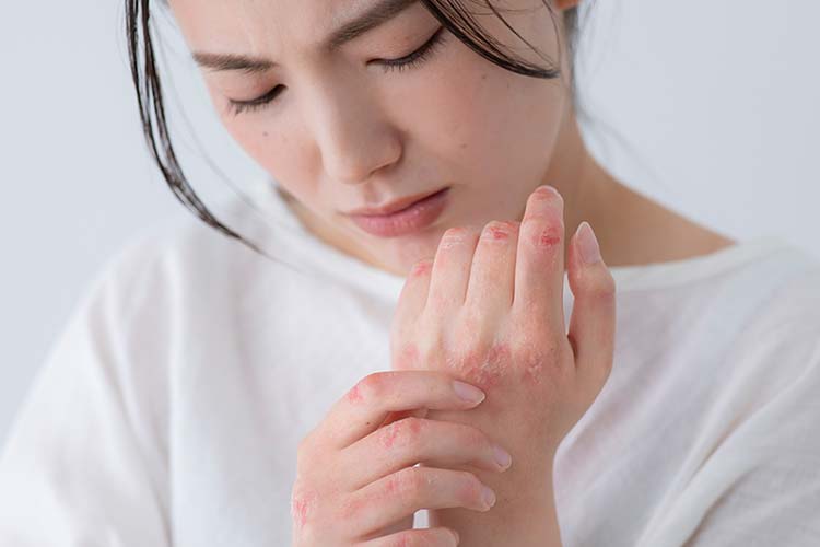 アトピー性皮膚炎