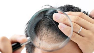 気になる生え際